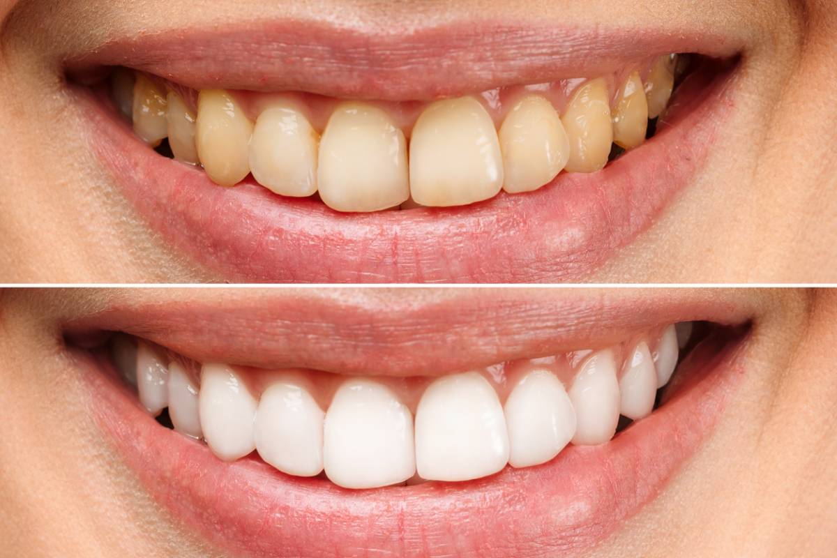 blanchiment dent beauté